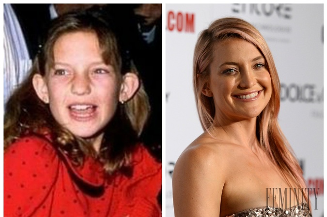Kate Hudson je dnes očarujúca kráska, čo sa v mladosti nedalo povedať.