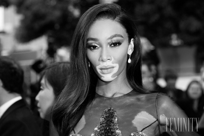 Winnie Harlow rúca tradičné štandardy krásy, napriek tomu, že jej inakosť je neprehliadnuteľná